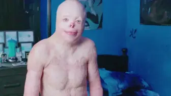 一个全身烧伤面积达95%的年轻人