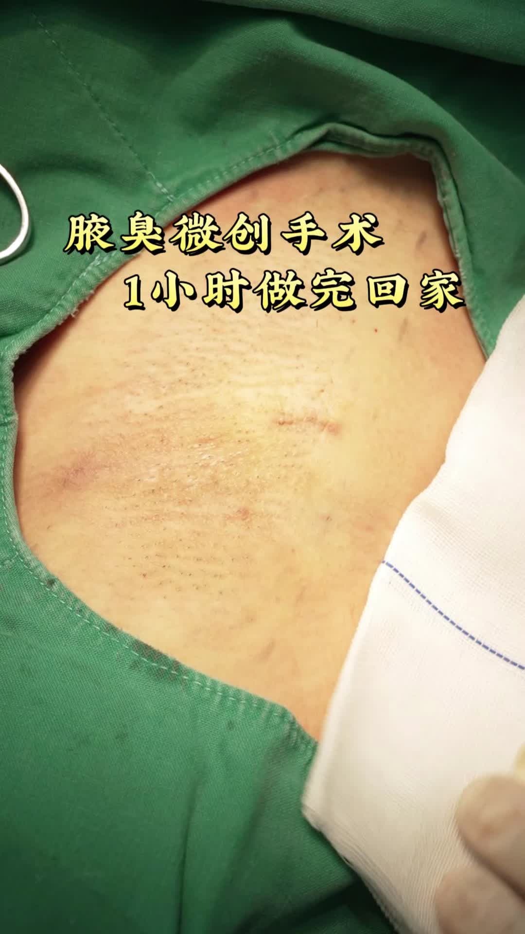 腋臭微创手术一小时回家