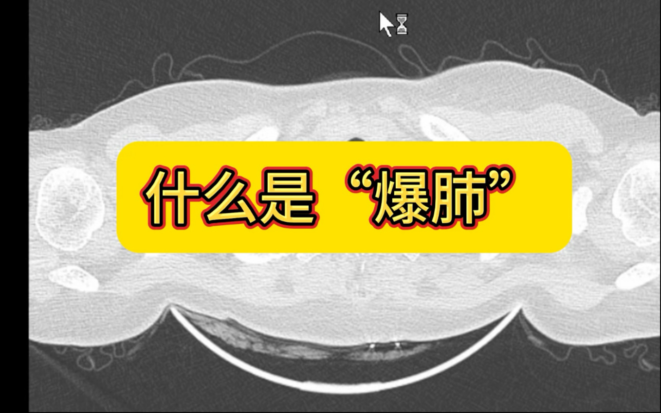 什么是爆肺，那些人要警惕爆肺？