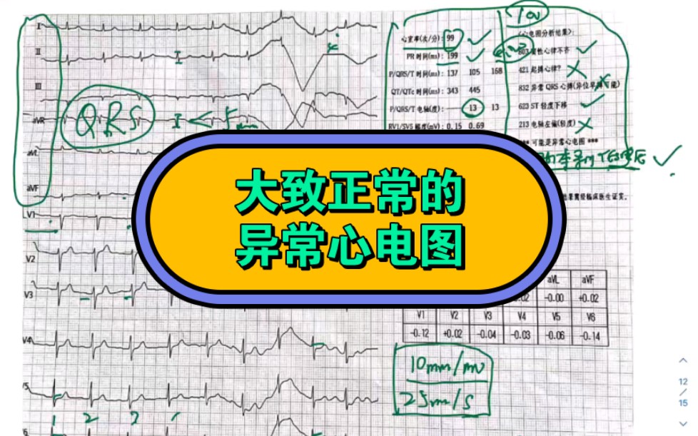 大致正常的异常心电图,窦性心律不齐,低电压,stt改变哔哩哔哩bilibili