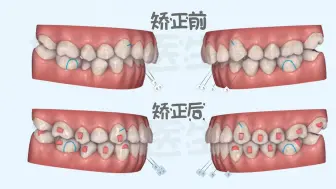 Download Video: 推磨牙向后矫正深覆合牙齿