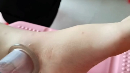 扭伤脚后的拔罐养生保健