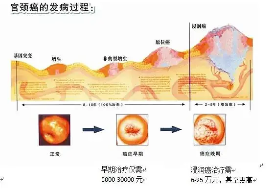 早期浸润癌会复发吗 哔哩哔哩