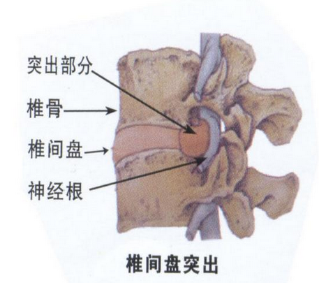 延安椎间盘突出邱悬壶图片