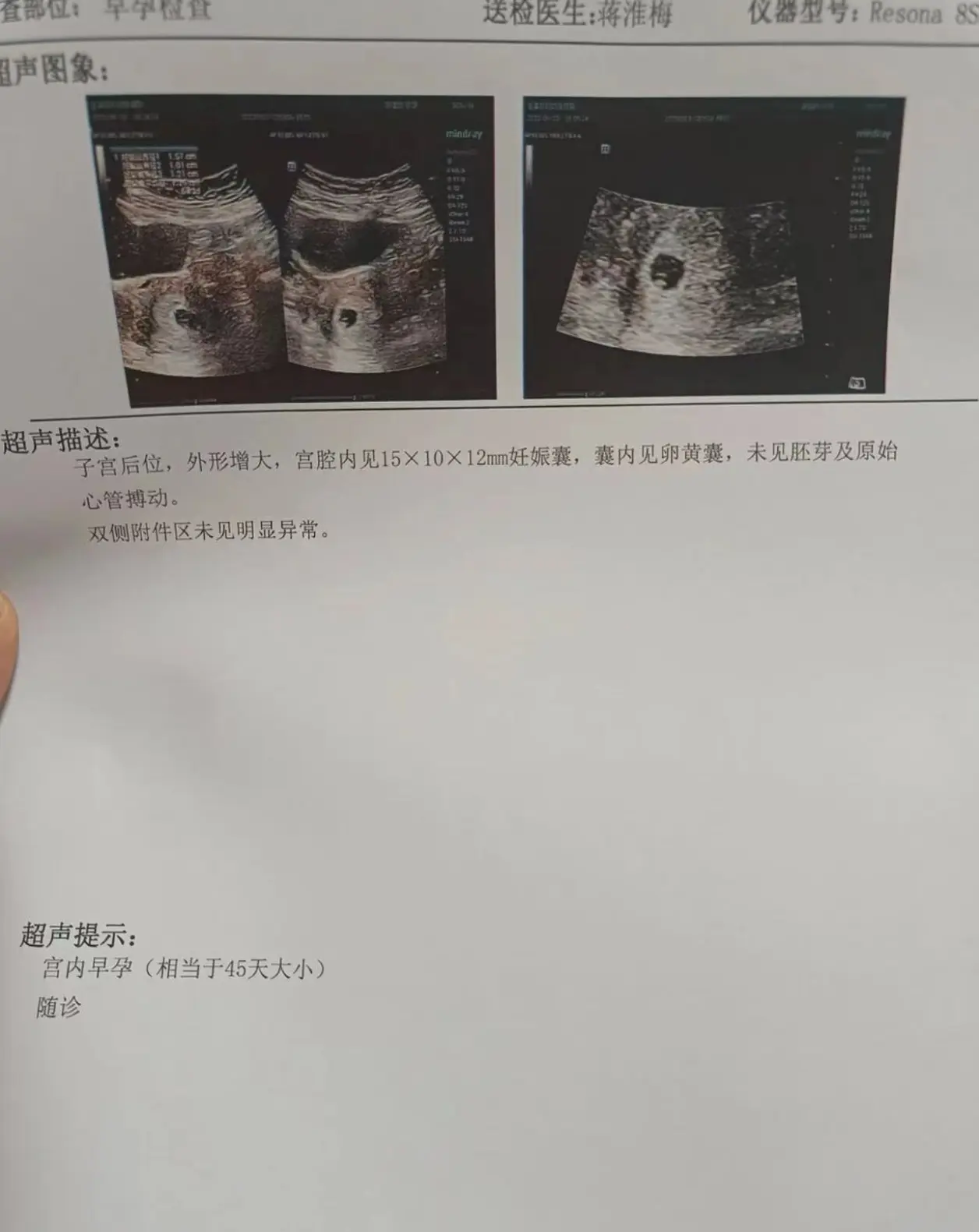 药物流产一般得多钱(药物流产多少钱 大概)