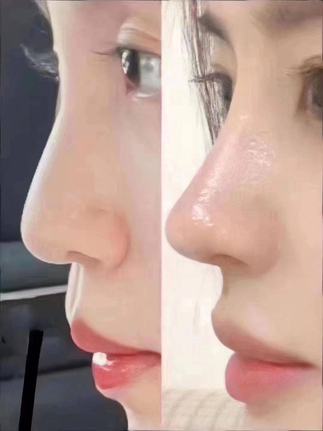 分享微驼峰鼻子模版鼻综合手术 🧐🧐最近很多姐_圈子-新氧美容整形