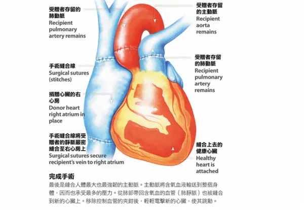 知识图解:心脏移植手术的步骤