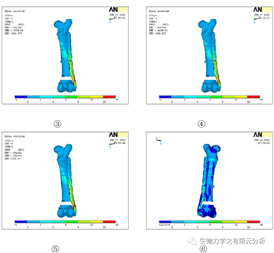 Liss Df治疗股骨远端骨折的三维有限元分析 哔哩哔哩