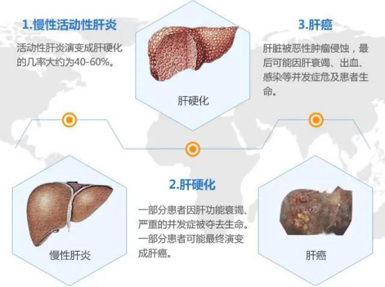 科普肝硬化失代偿期情况有多严重