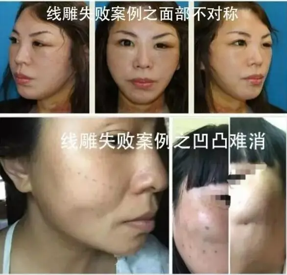 线雕后多久可以化妆 埋线的副作用有哪些 服了服了 哔哩哔哩