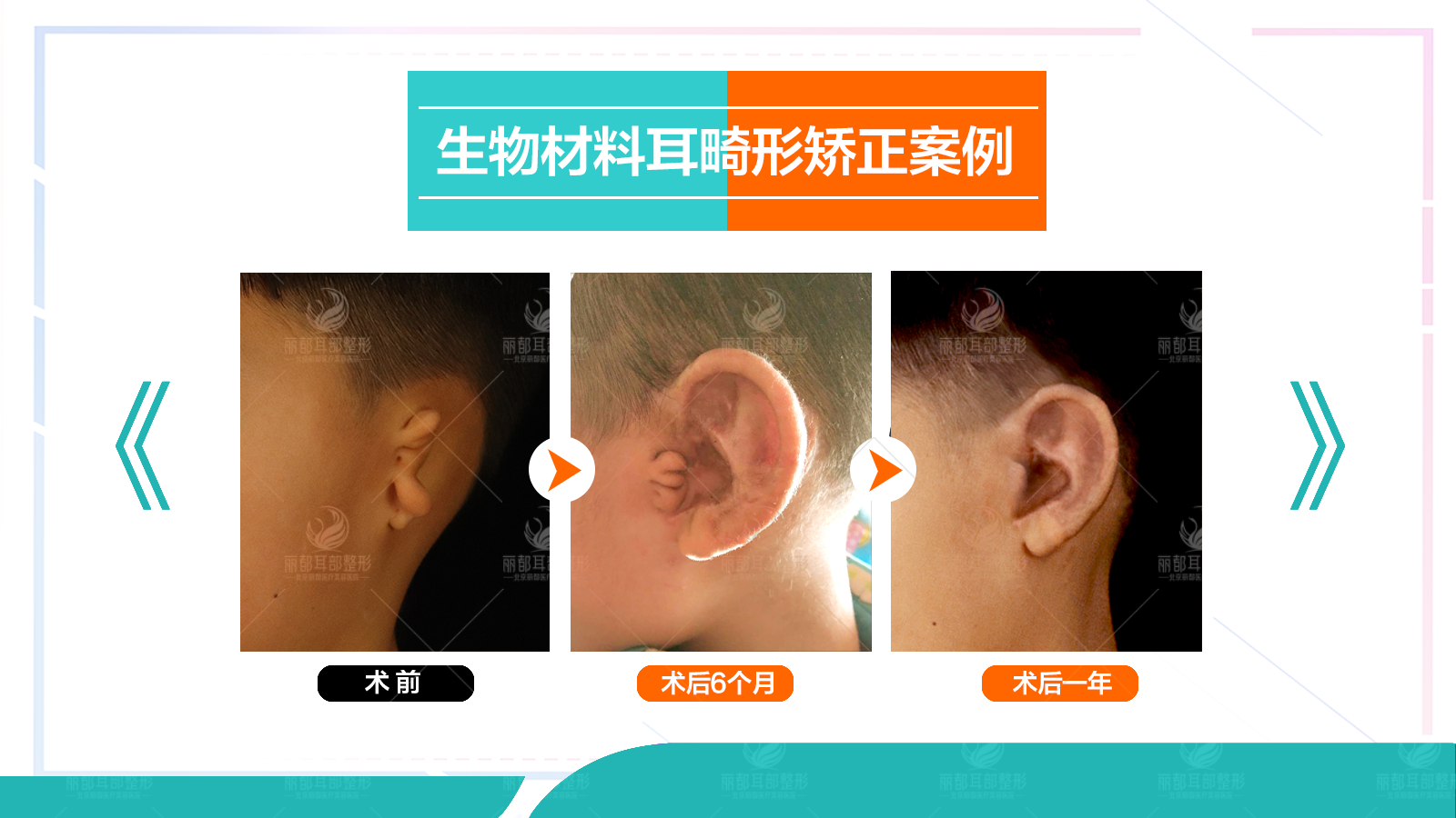 【案例故事】小耳畸形患者：女朋友陪我来广做耳再造手术_耳朵_效果_回院