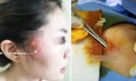 线雕面部提升术后遗症有哪些,线雕一年后脸部增生了
