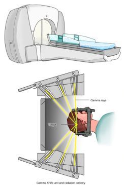 同时,伽马刀同手术切除一样,是利用放射线,对定位病灶内的癌细胞的