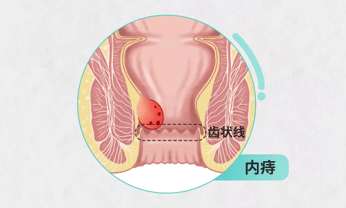 内痔如何一步步的"消耗"你的肛肠健康!