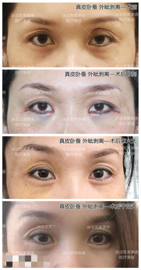 张冰洁自体真皮卧蚕丨外切祛眼袋卧蚕消失,看自体真皮如何找回卧蚕