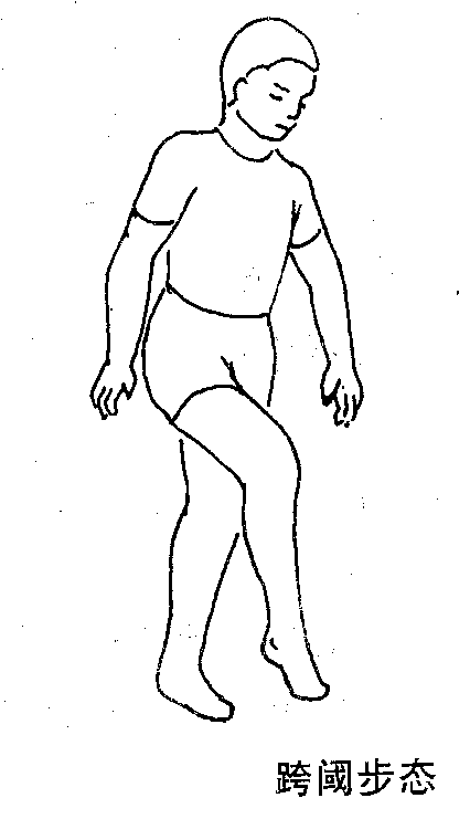 常用步态参数及常见异常步态 - 哔哩哔哩