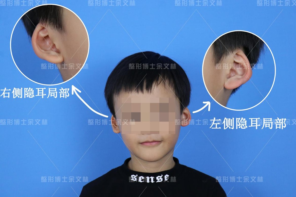 郭志华-耳畸形之隐耳矫正手术方案 - 哔哩哔哩