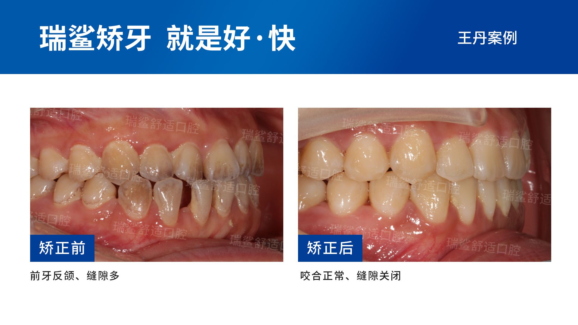 地包天的牙齿矫正方法有哪些_深圳爱康健口腔医院
