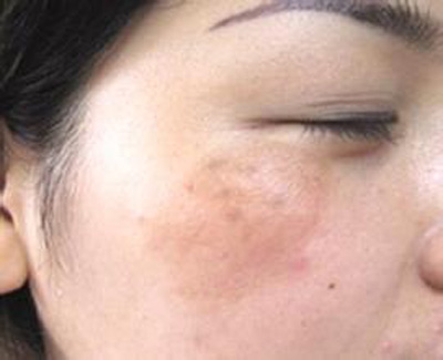 怎么祛除黄褐斑,激光黄褐斑靠谱?