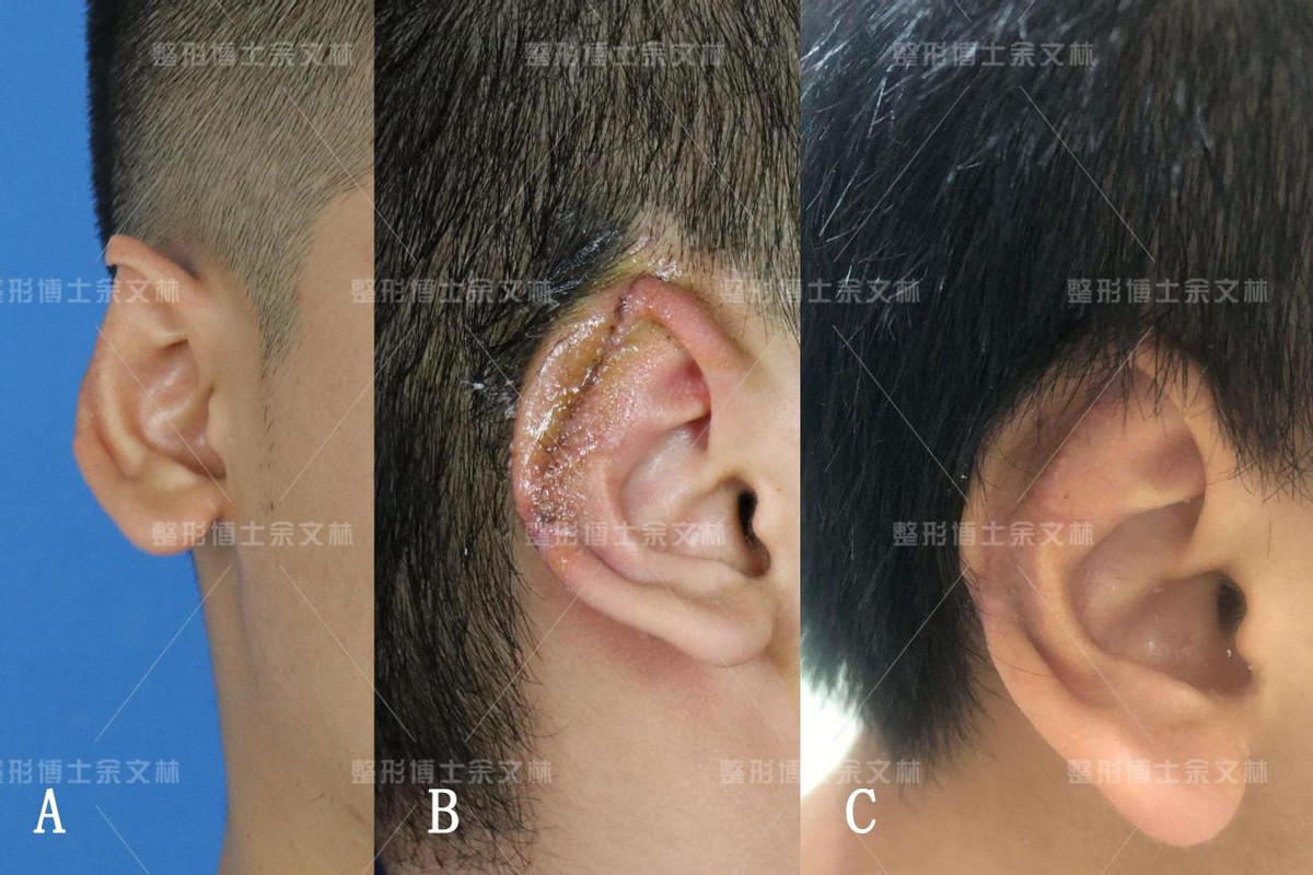 耳再造的手术的6大步骤你了解的有多少？ - 哔哩哔哩