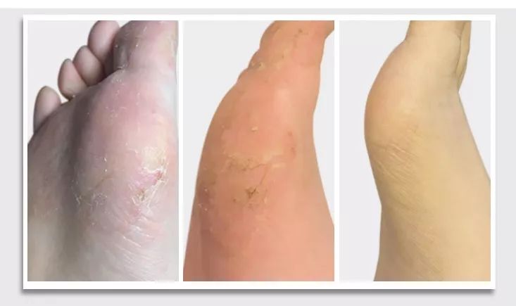 案例1: 高中生小蒙,18年3月份感染足菌,觉得脚痒一个月左右,脚底出现