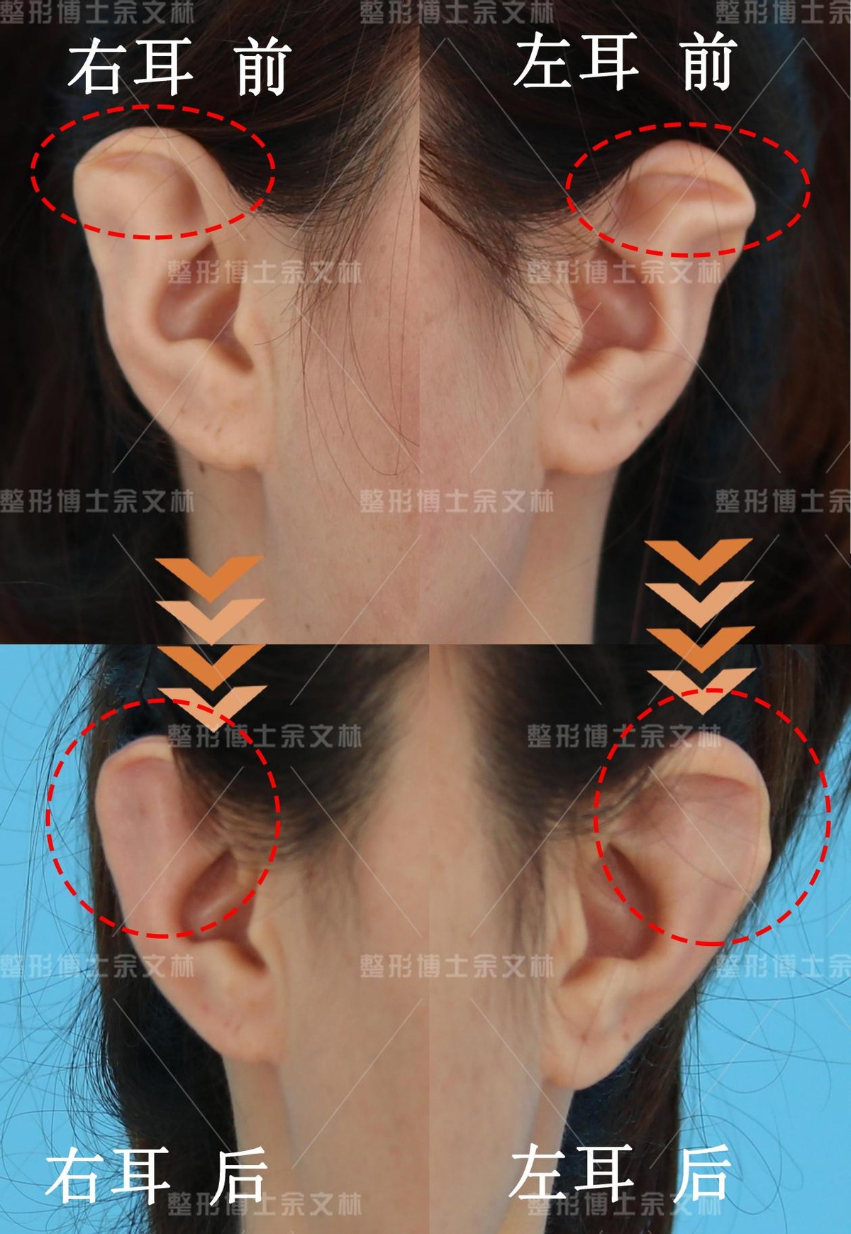 第一节 先天性耳前瘘管切除术-耳鼻咽喉头颈外科手术-医学