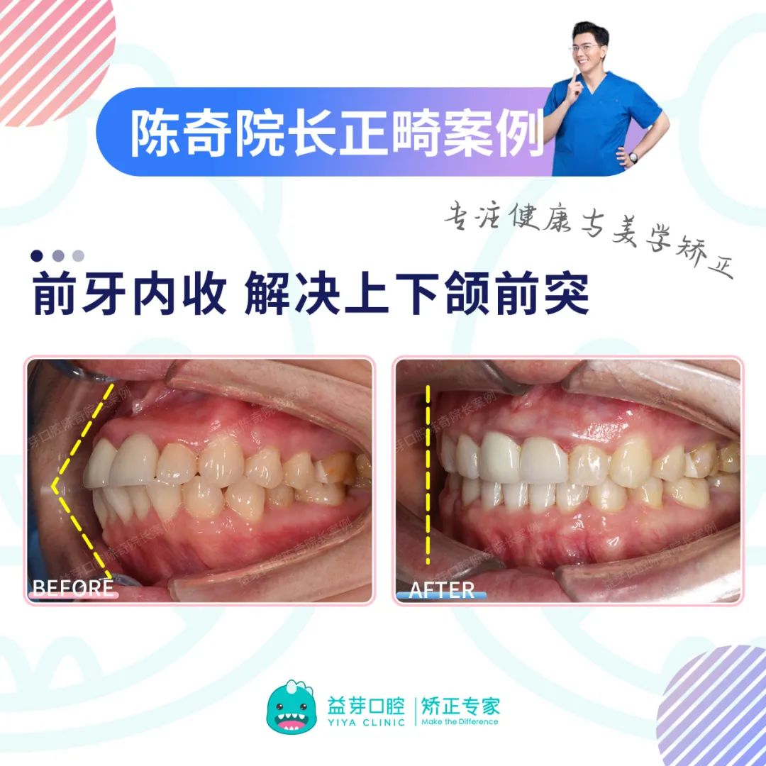 上海张晓建医生案例分享：下巴取生长因子术后即刻效果 - 知乎
