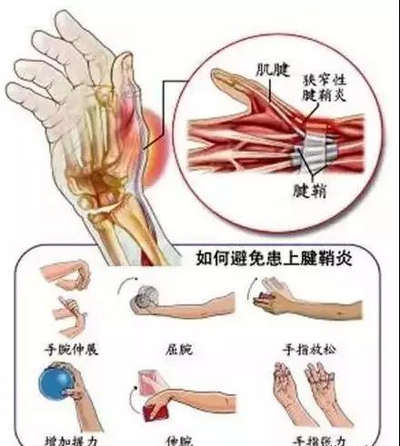 握拍不正确导致虎口疼痛怎么办快看几招恢复方法