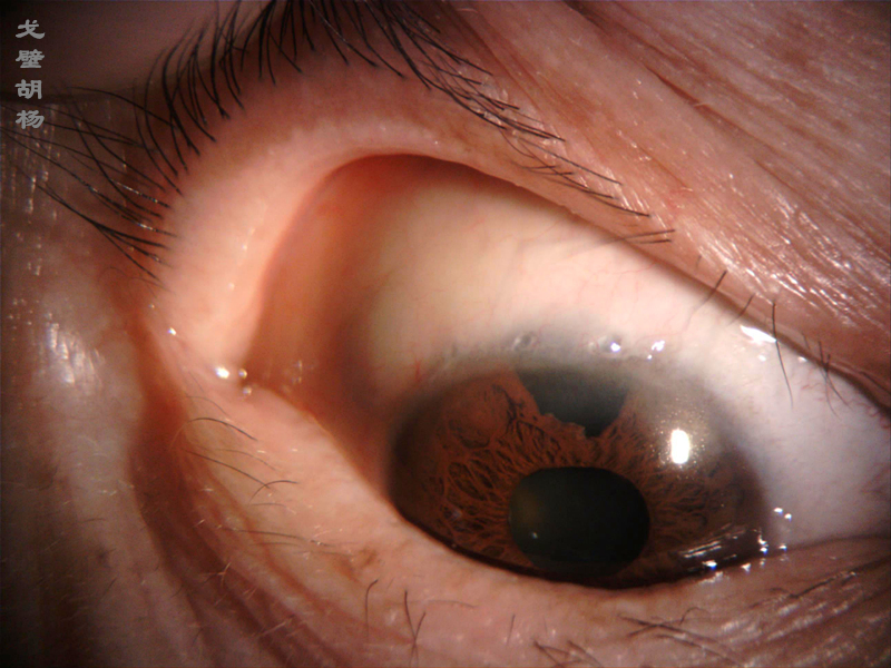 青光眼与虹膜造孔