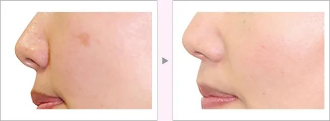 激光or皮秒 到底谁才是 磨皮美颜界 的扛把子 热备资讯