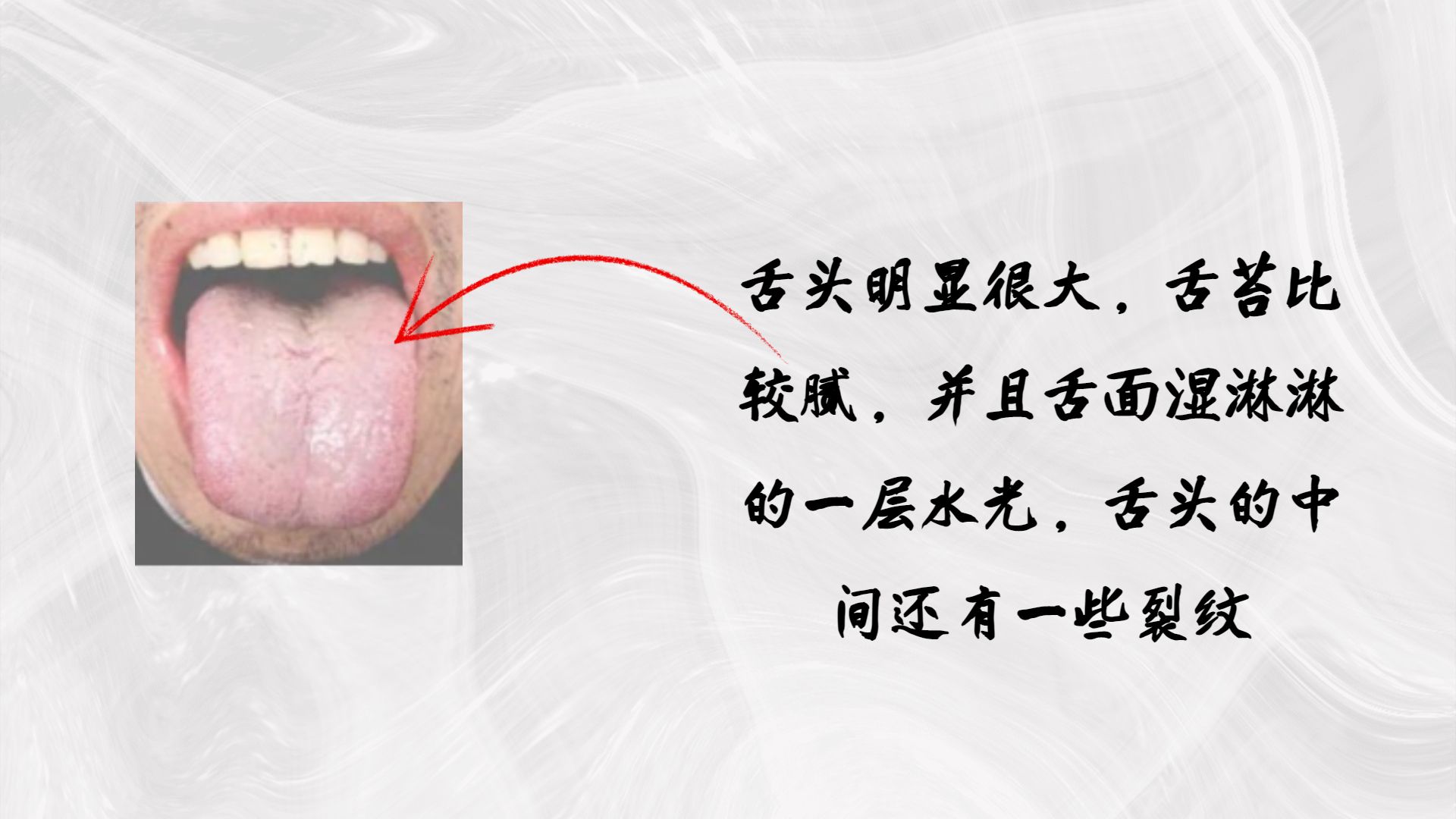 【实践分享】舌苔白厚、黑舌苔、地图舌、裂纹、锯齿、齿痕、肥大、舌下青筋、口疮溃疡、唇色 | 安疗网