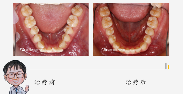 鄭州隱適美牙齒矯正醫生常大桐:隱適美矯治牙列擁擠,牙弓狹窄病例