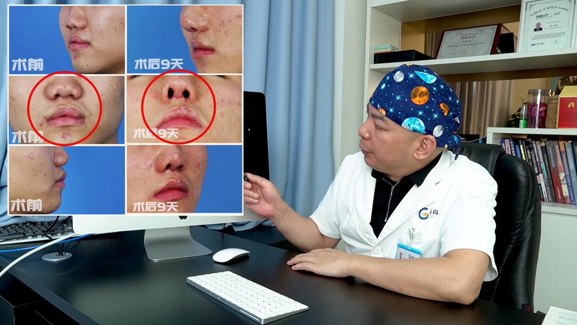 唇裂鼻子塌陷怎么修复：不对称唇裂鼻畸形案例 - 知乎