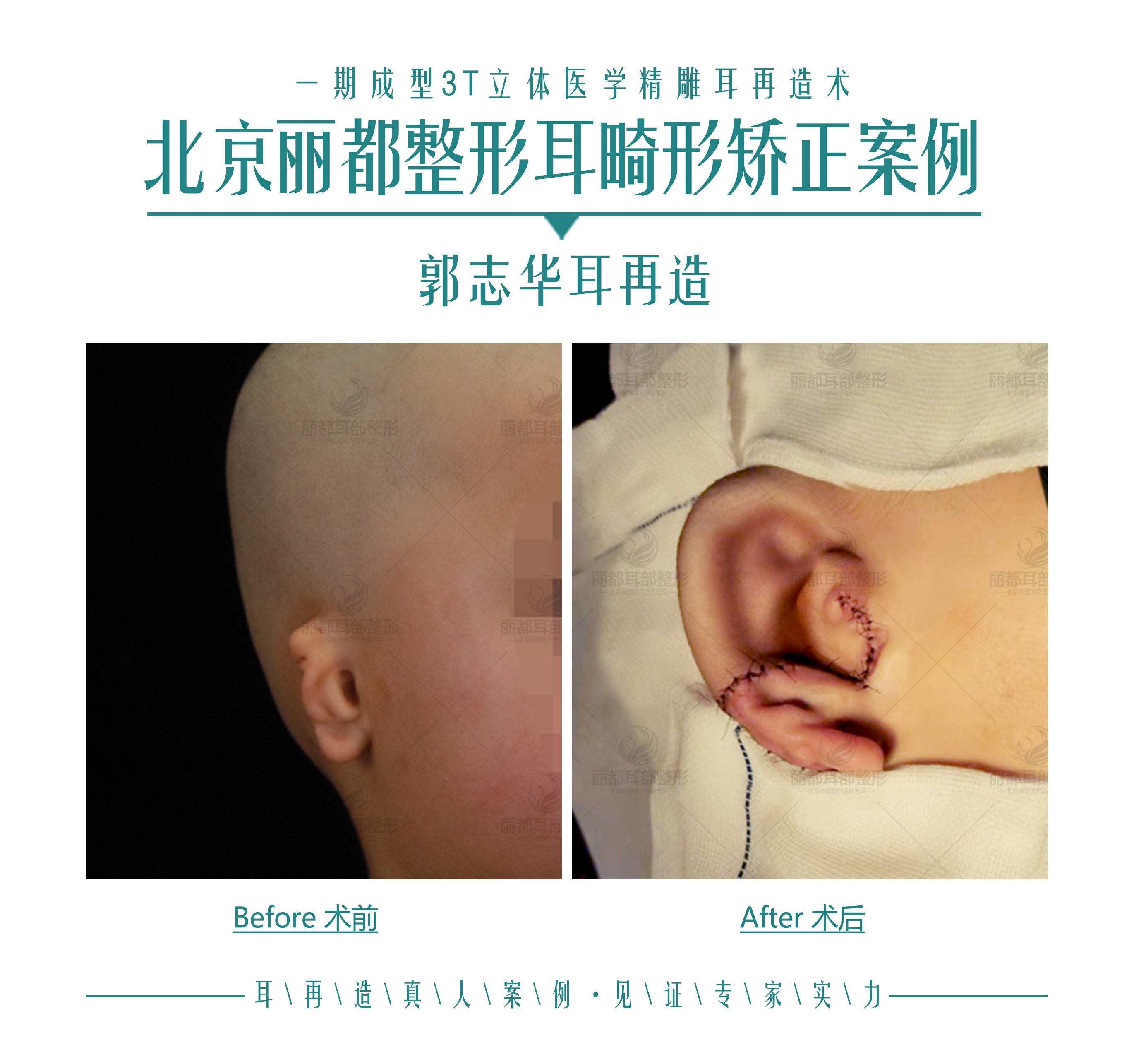 小耳畸形：二期耳再造手术的术后恢复_耳再造_治疗方式_护理及注意事项 - 好大夫在线
