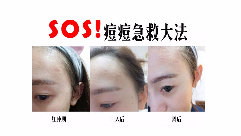 Sos 已经红肿 发炎的痘痘的快速急救方法 内附对比图 哔哩哔哩