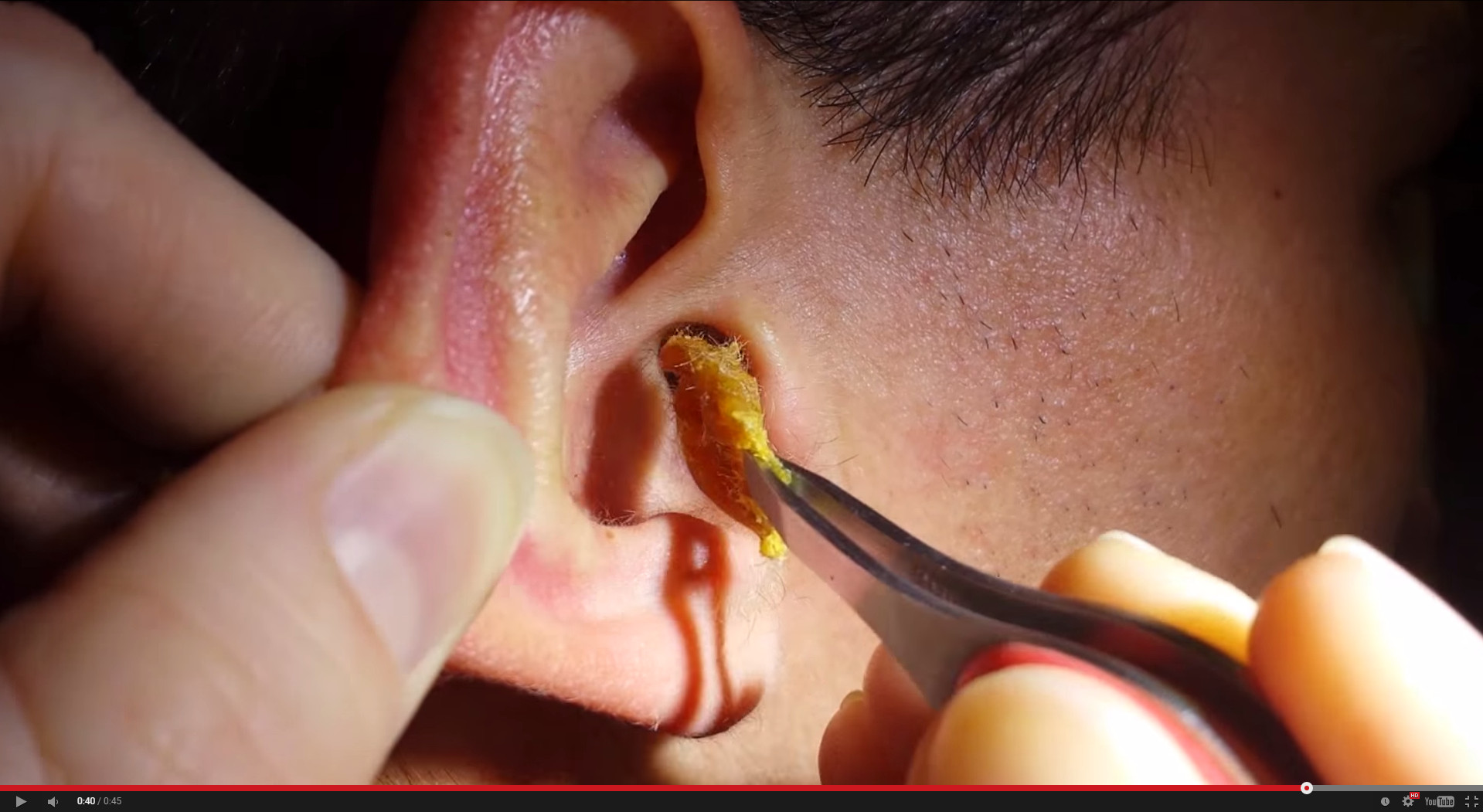 被再用棉签掏耳朵了!英国一男子棉签掏耳朵导致男子引发"脑膜炎"