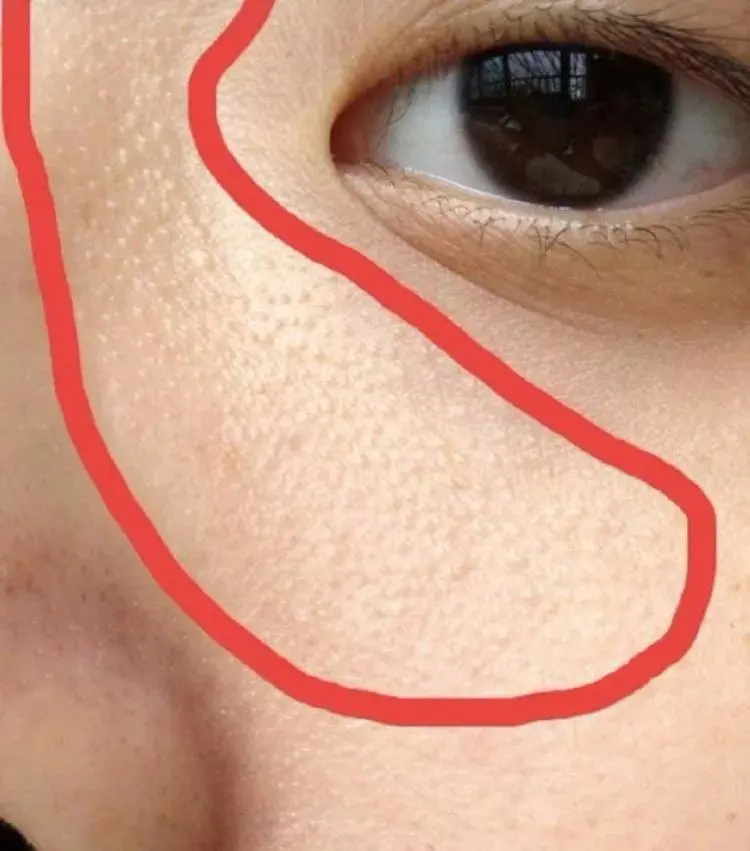 眼周脂肪粒 可能是毛周角化 哔哩哔哩