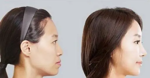 英煌王勋讲什么是鼻基底 哔哩哔哩