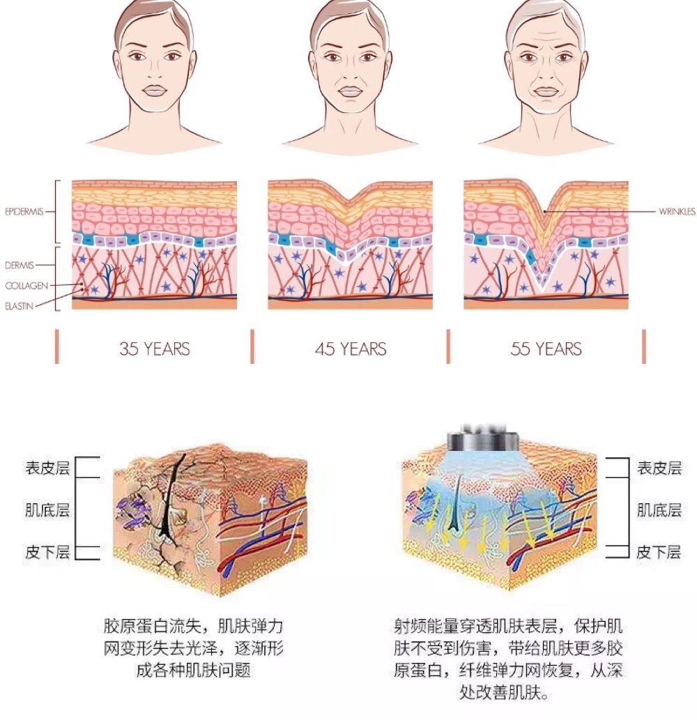 这肯定是最全的射频类美容科普了!抗衰必看!