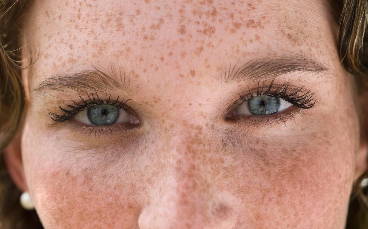 脸上有斑点怎么办如何消除（脸上长斑怎么办？了解四个因素，对症治疗） | 说明书网