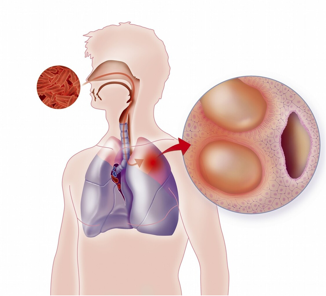 什么是肺结核，传播途径有哪些？怎么可以有效预防肺结核？