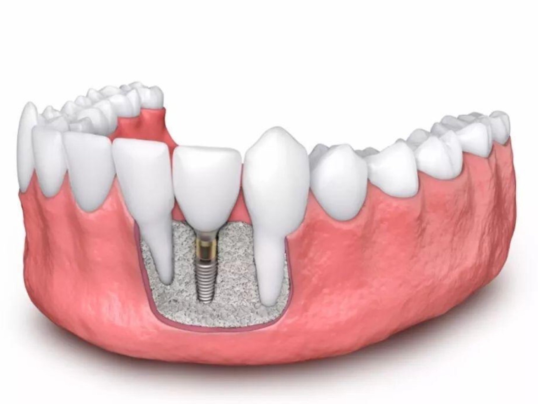 种植牙真实过程片，种植牙的全过程是什么样