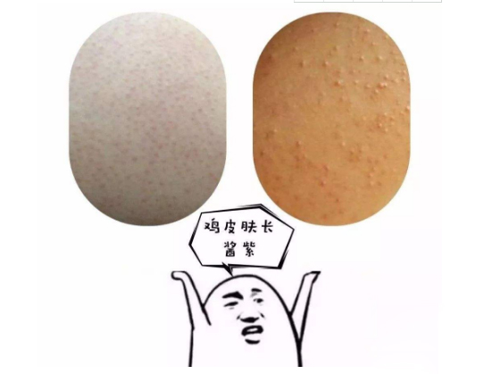 却鸡皮肤(鸡皮肤啥样子)