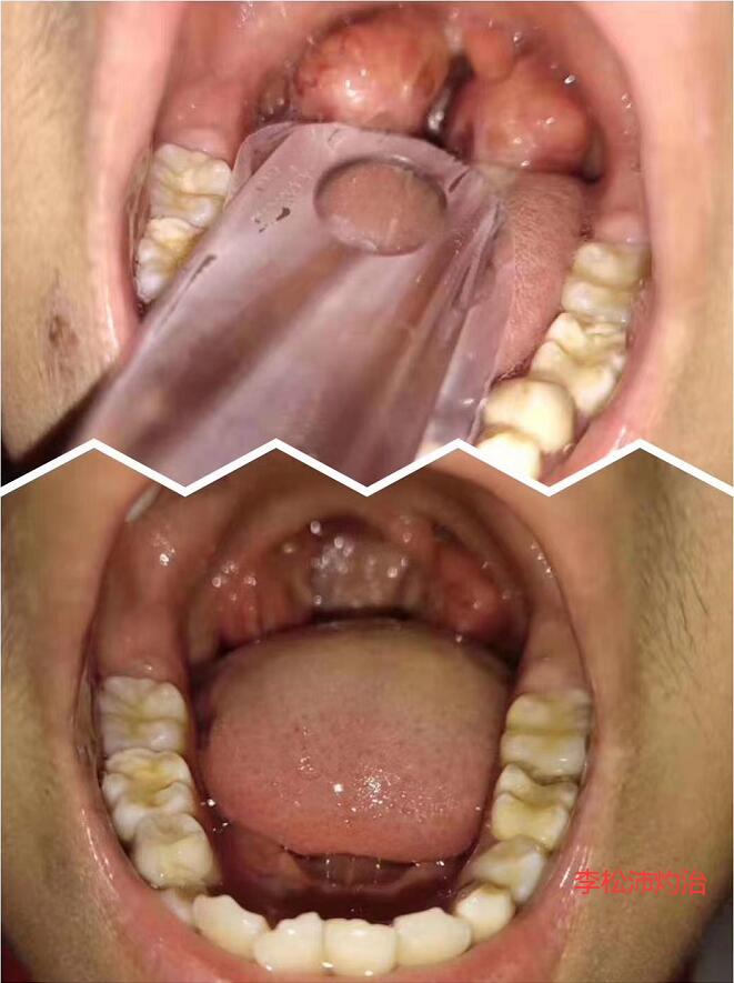 扁桃体灼烙后会坑洼不平吗?