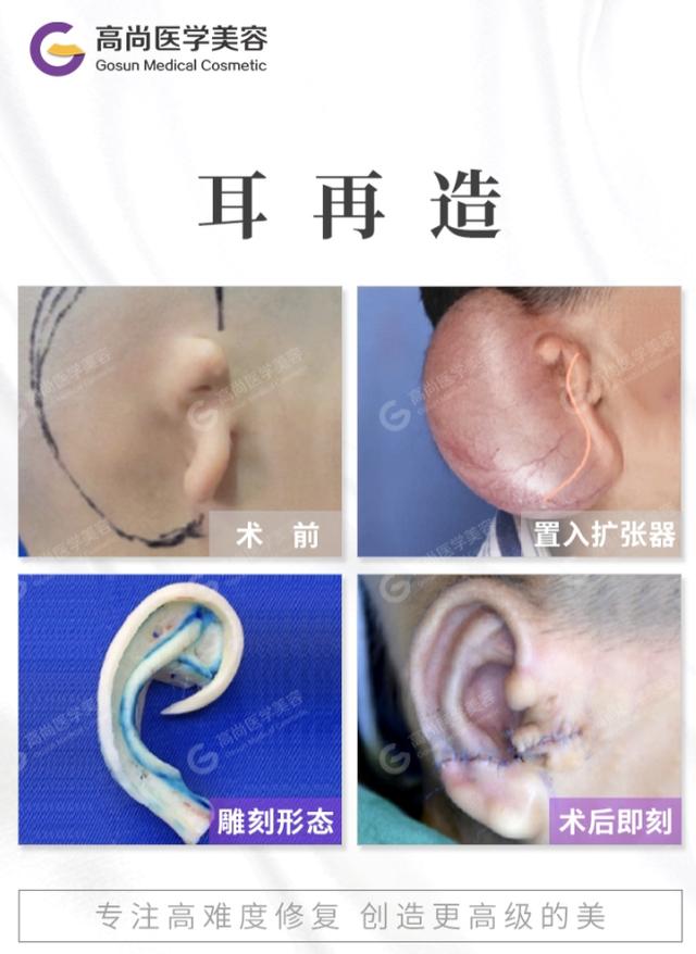 耳朵畸形怎么治疗图片