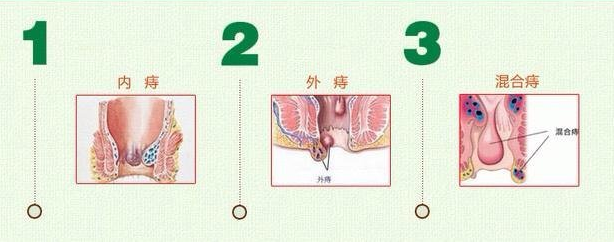 内痔、外痔、混合痔,哪种更危险? - 哔哩哔哩
