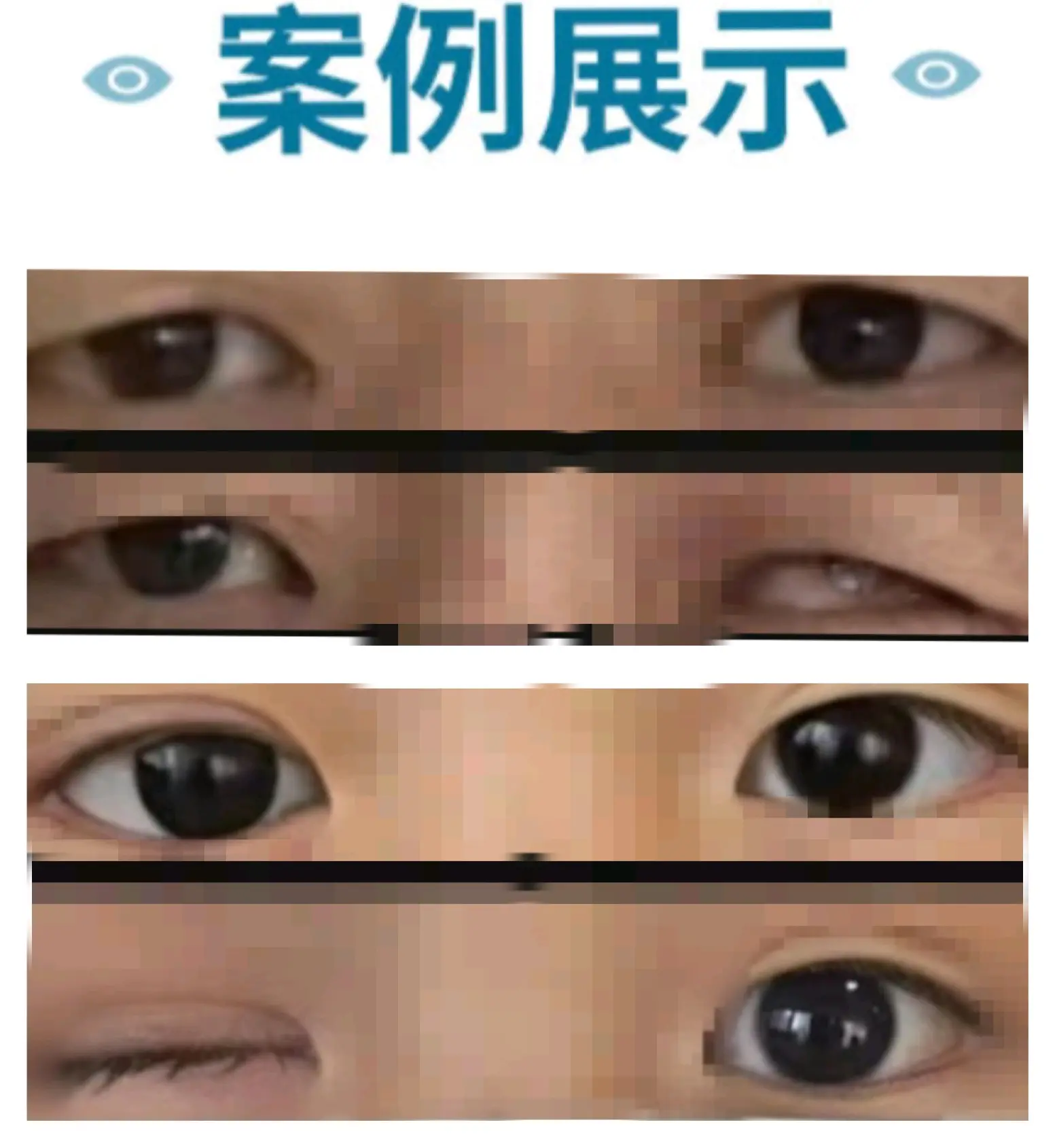 戴义眼片多少钱全国假眼义眼定制哪里做的最好北京天津河北石家庄义眼