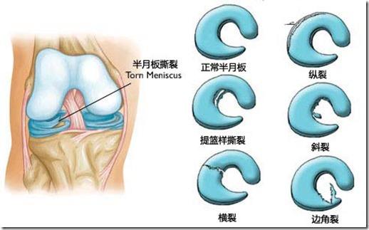 半月板引起的原因