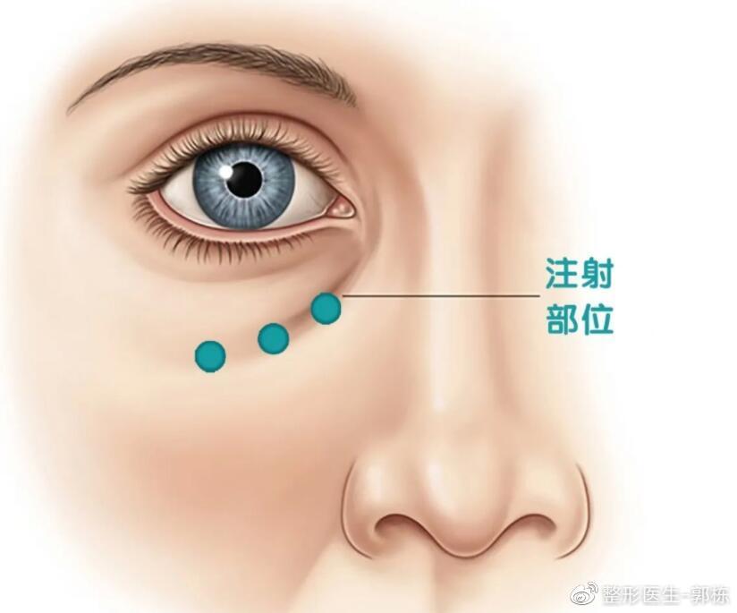 郭栋不开刀去眼袋4 0技术升级，效果立竿见影？ 哔哩哔哩