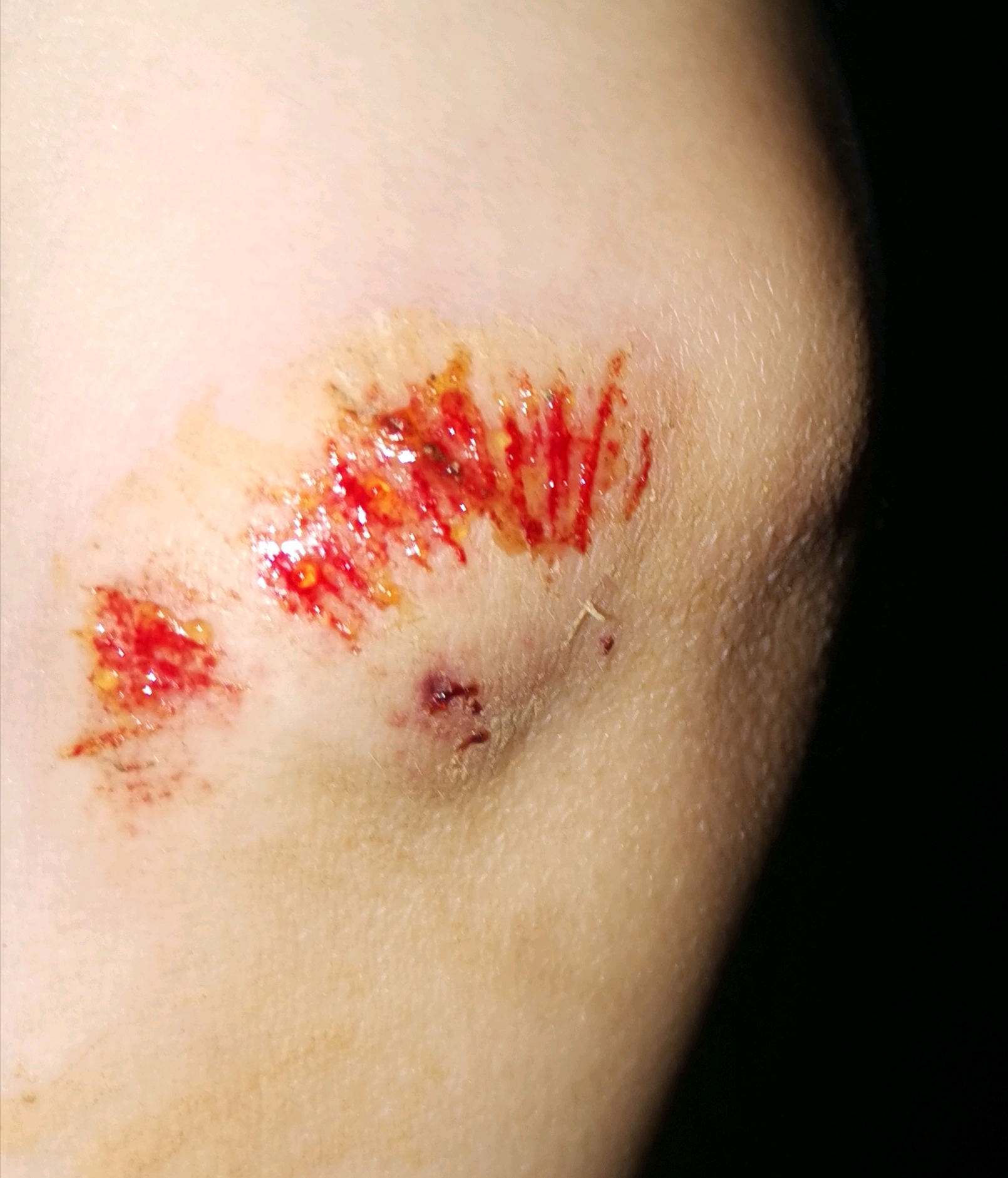 骑电动车摔跤伤口图片图片